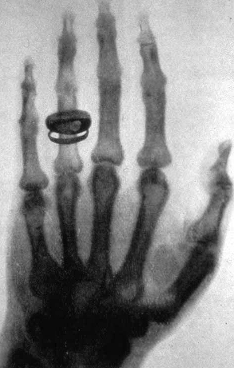 X-ray by Röntgen of Albert von Kölliker's hand