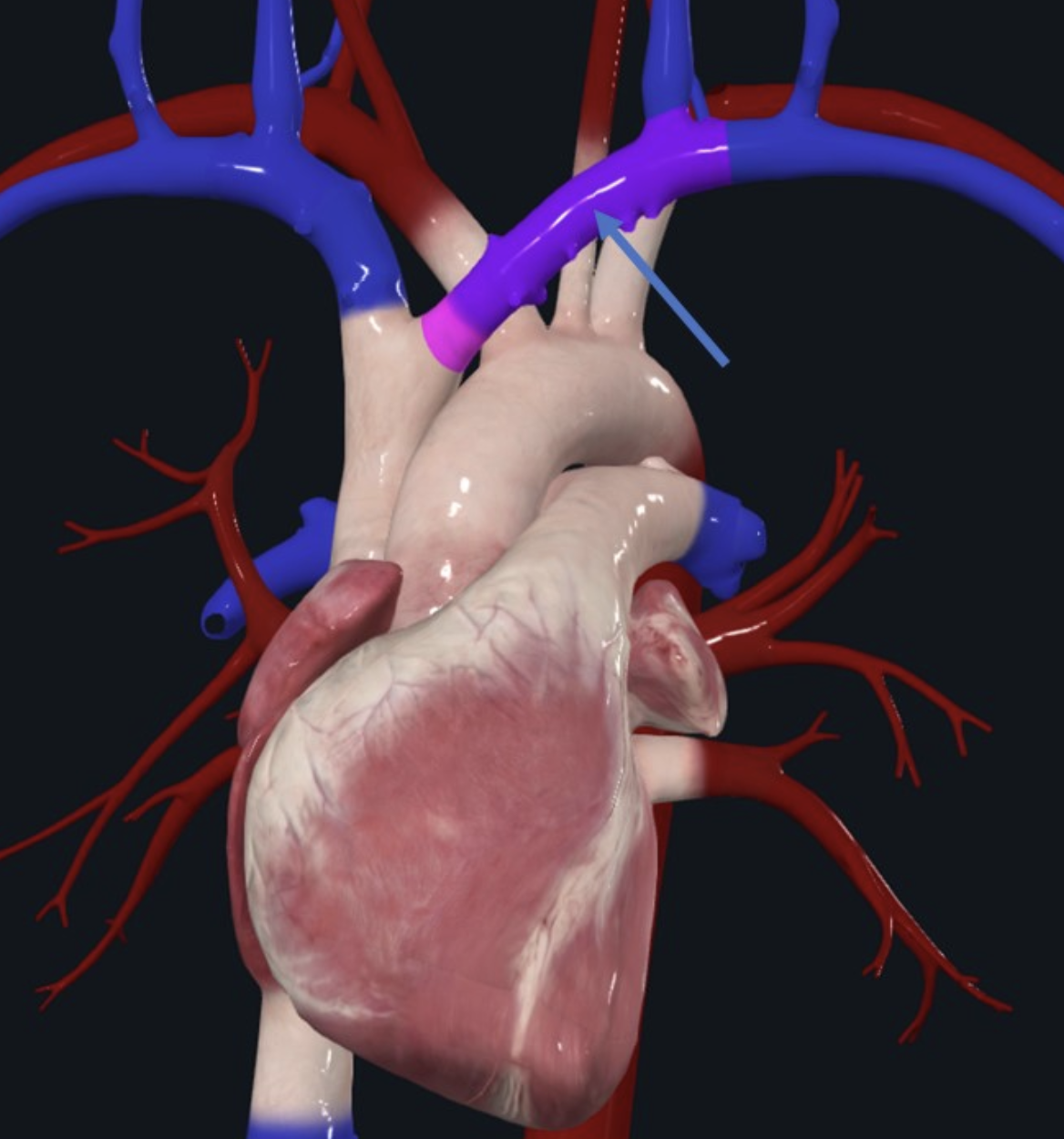 Brachiocephalic Vein