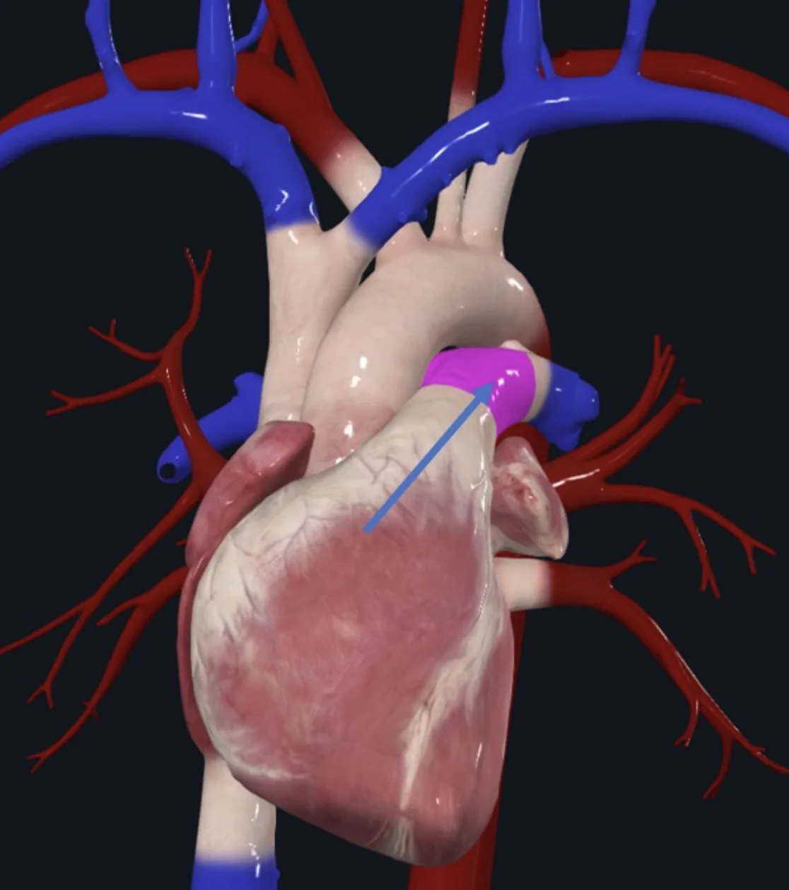 Pulmonary Trunk