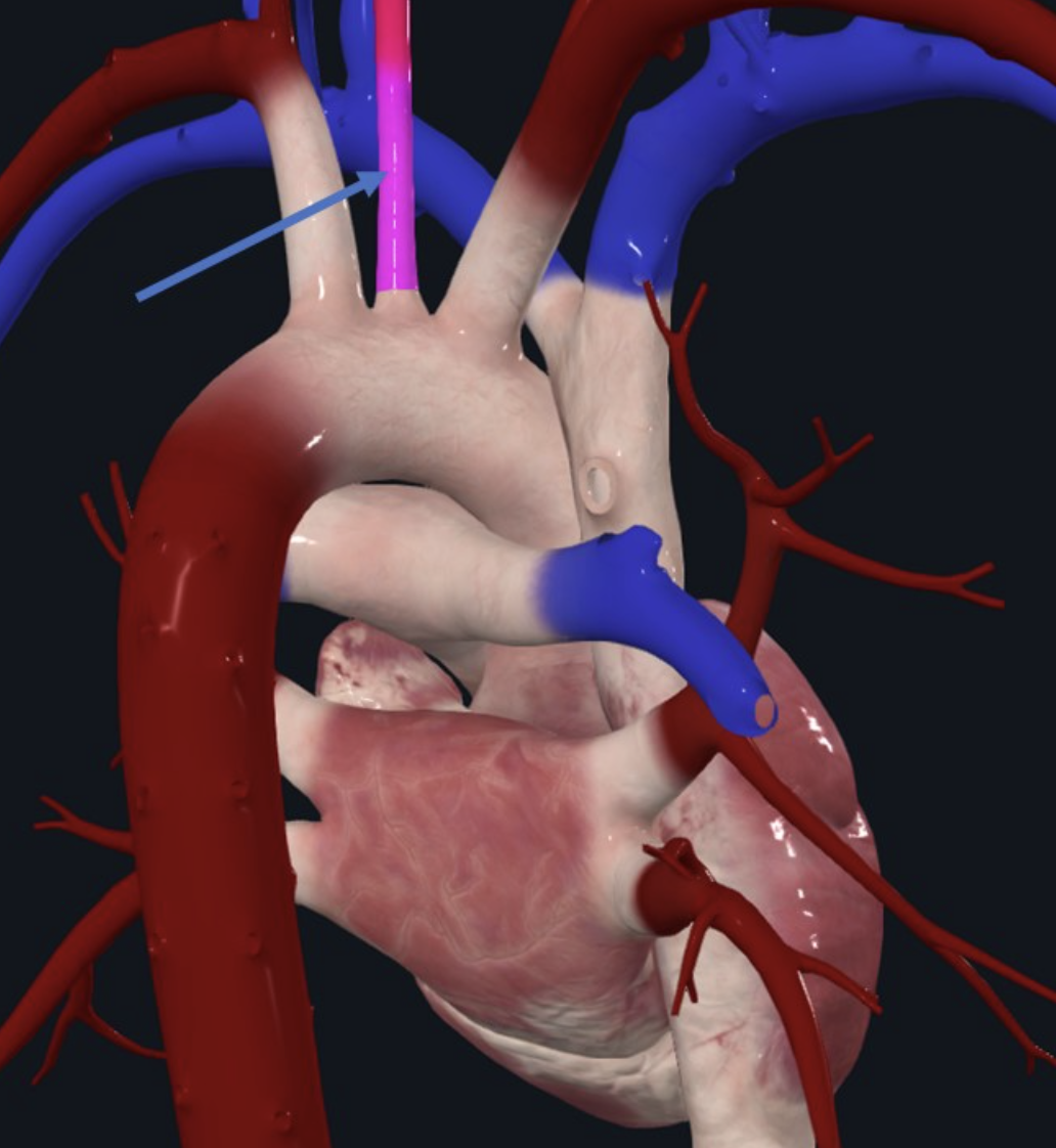 Left common carotid artery branching from the aortic arch
