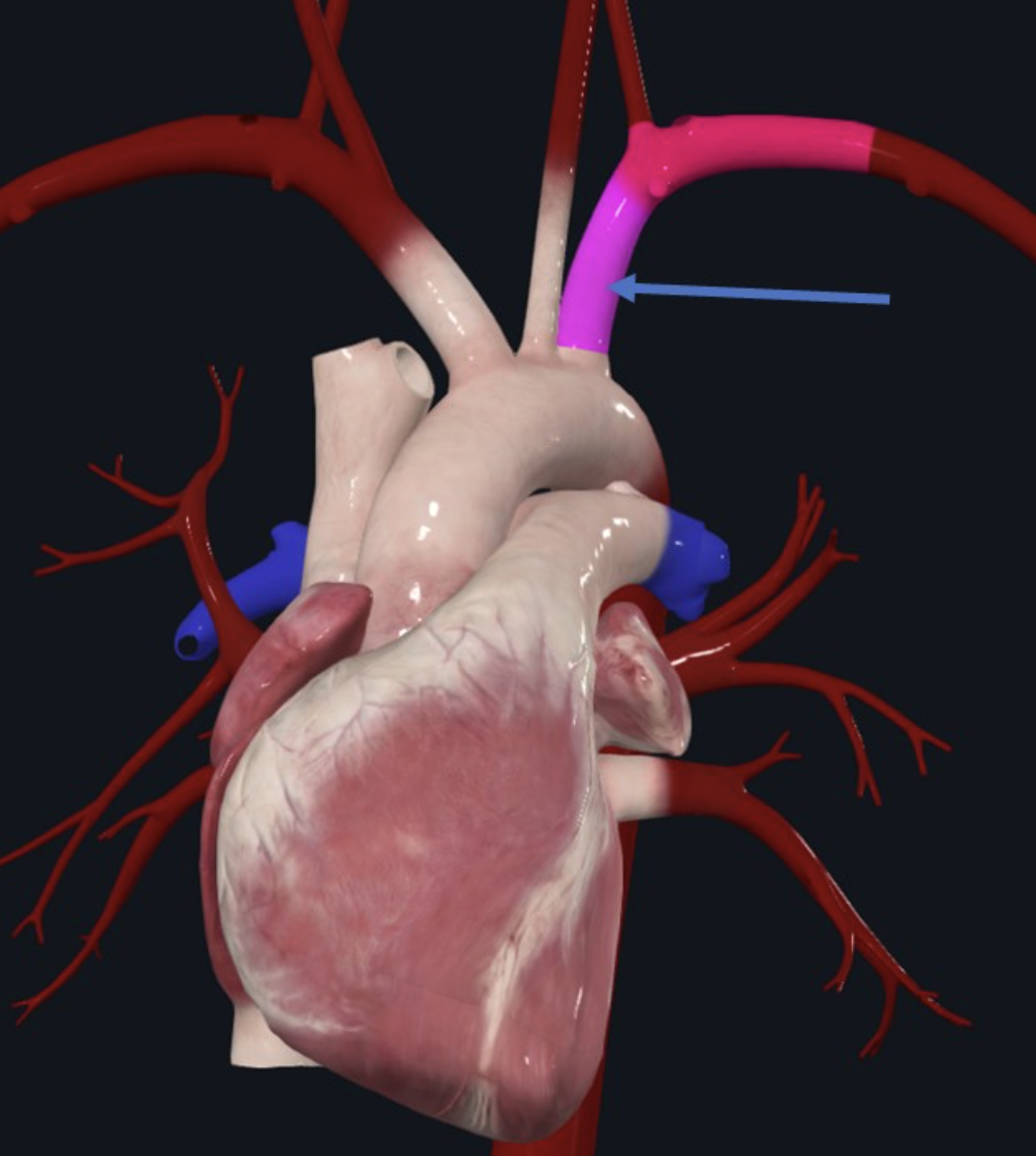 Left subclavian artery branching from the aortic arch