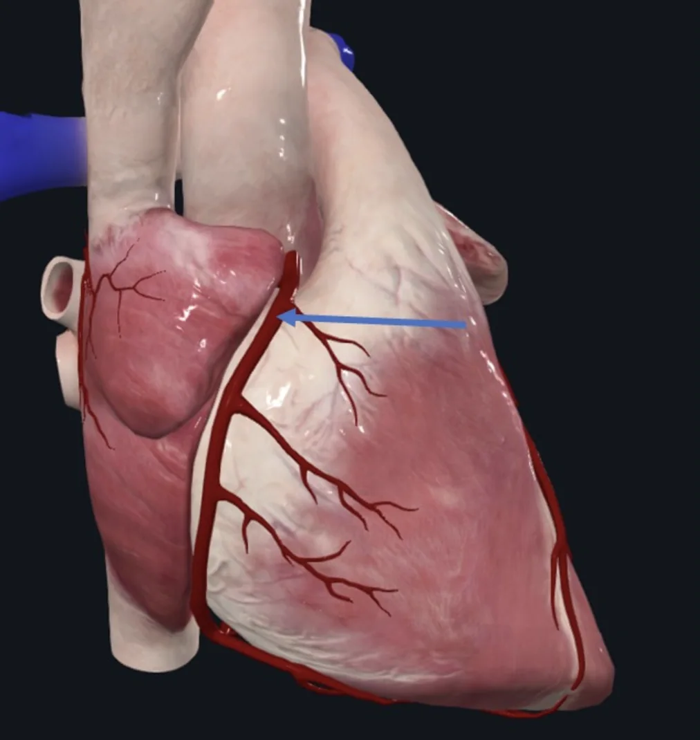 Right Coronary a.