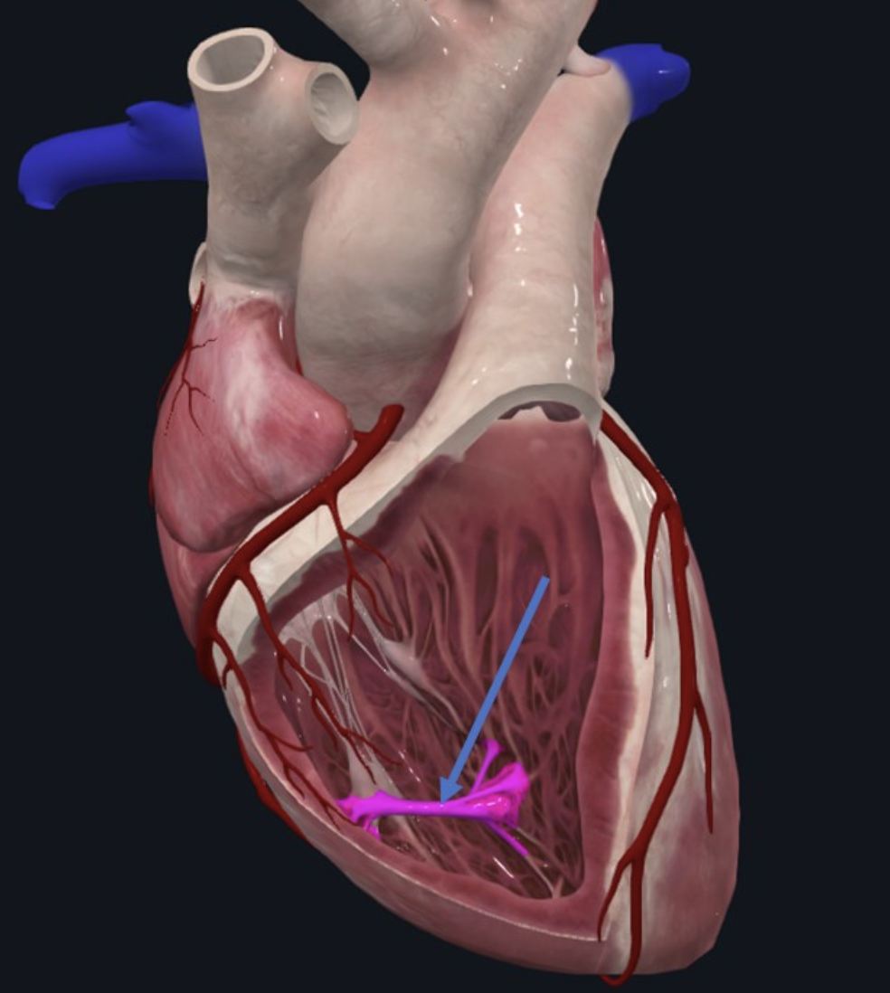 Septomarginal trabecula