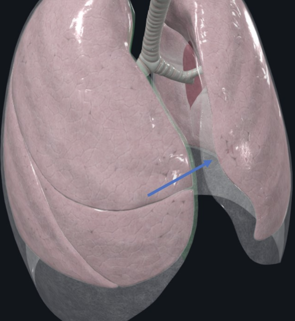 Costomediastinal recess