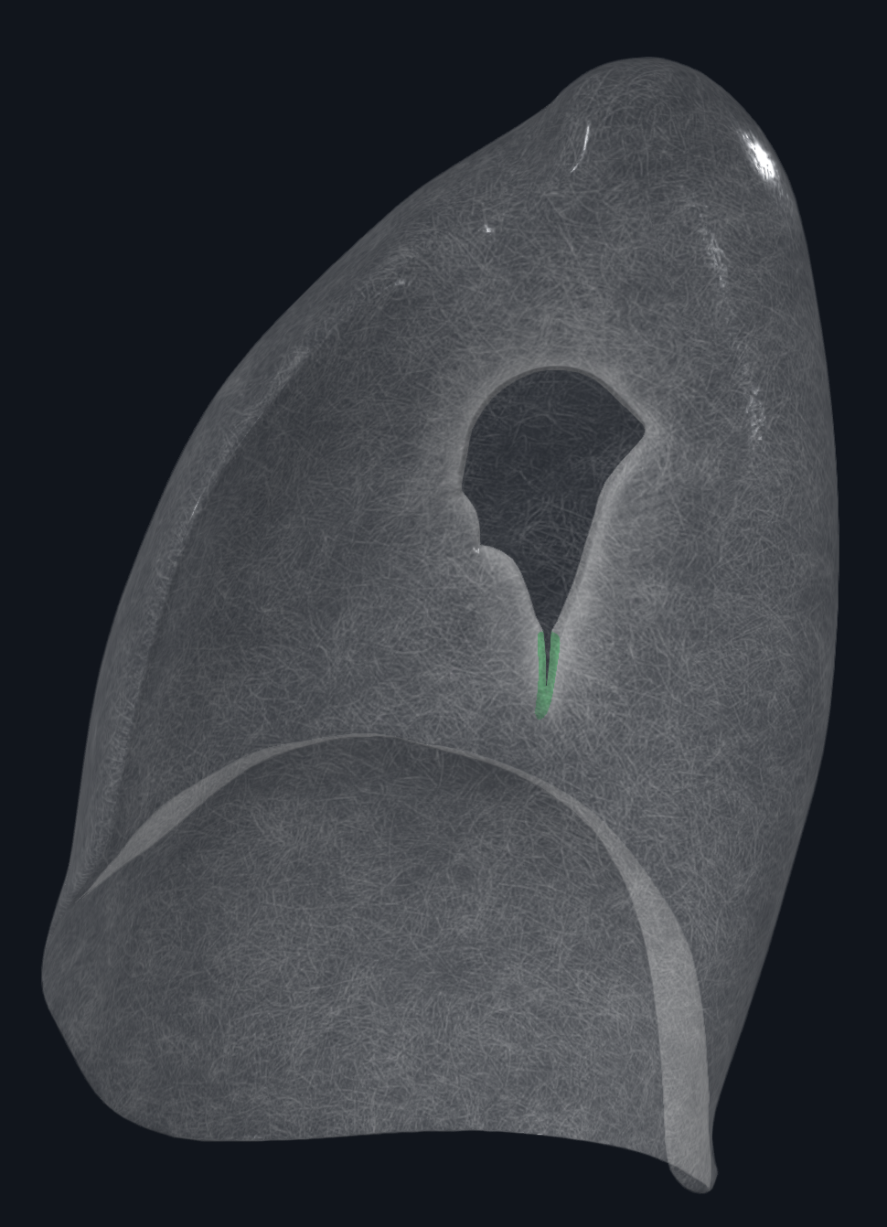 Pulmonary Ligament (Right Lung)