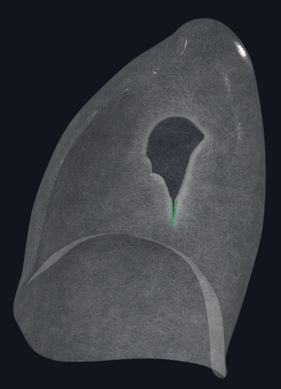 Pulmonary Ligament (Right Lung)