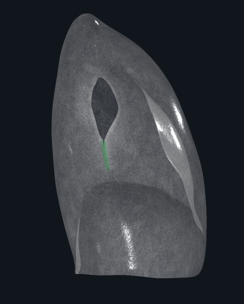 Pulmonary Ligament (Left Lung)