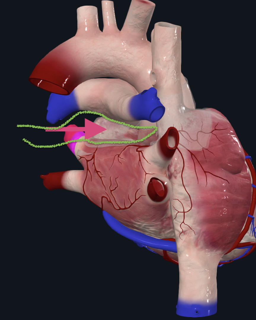 Transverse sinus boundaries