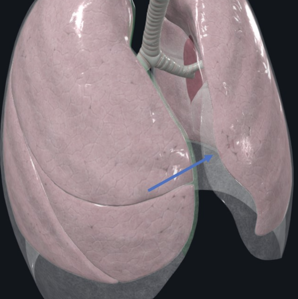Costomediastinal Recess