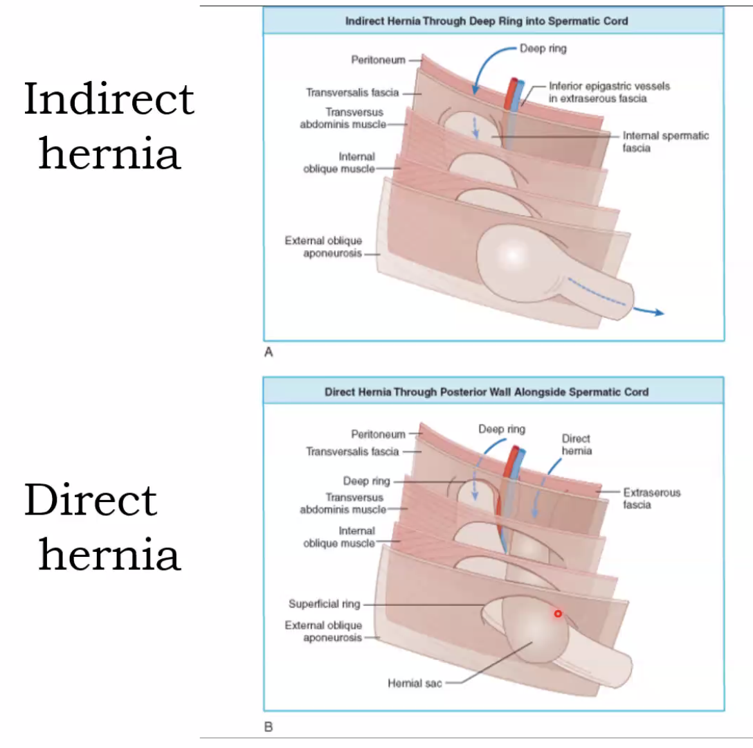 indirect and direct henria