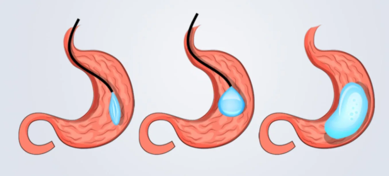 Intragastric Balloon
