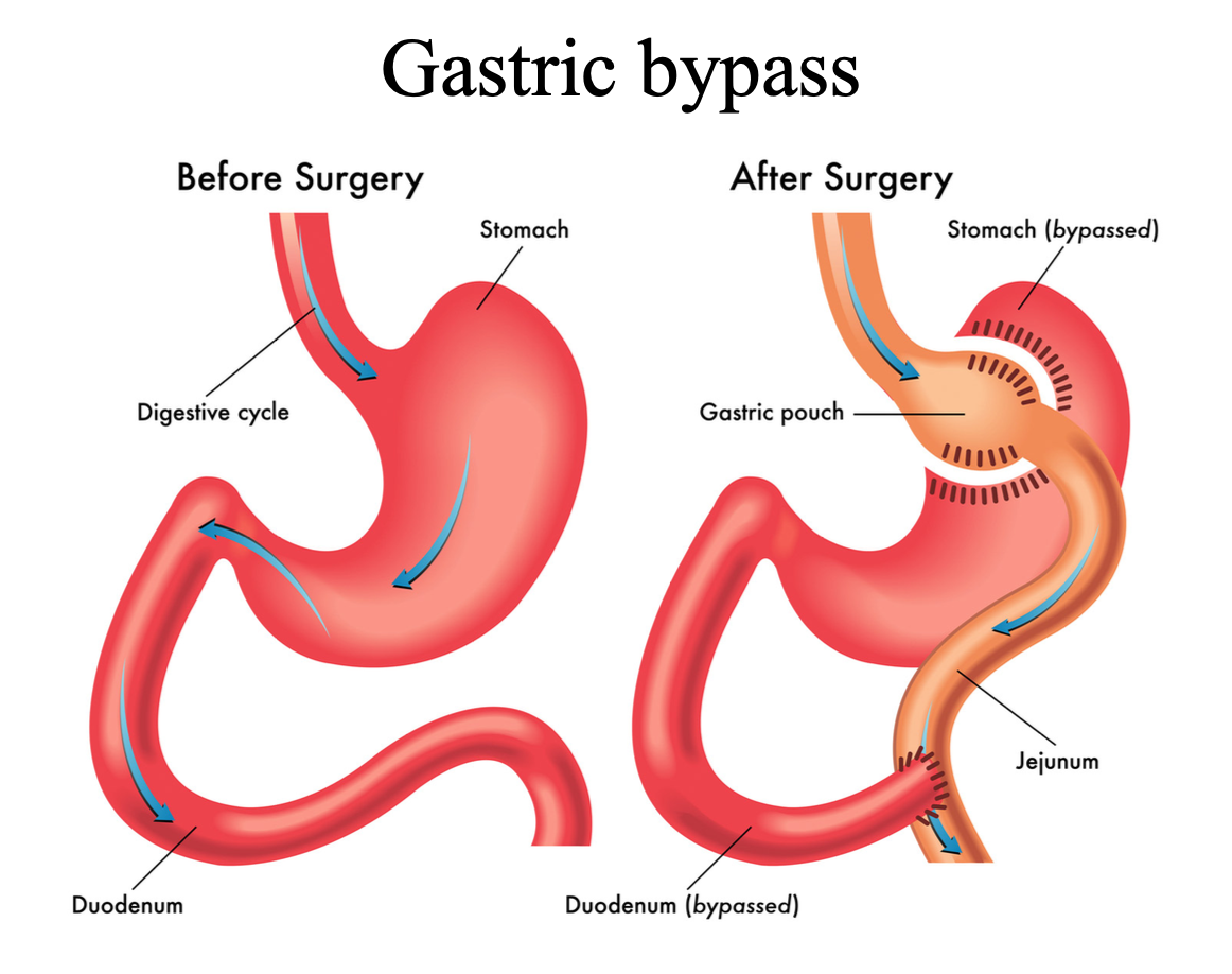 Gastric bypass