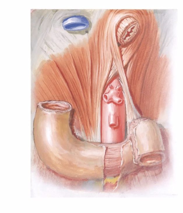Suspensory ligament of Treitz