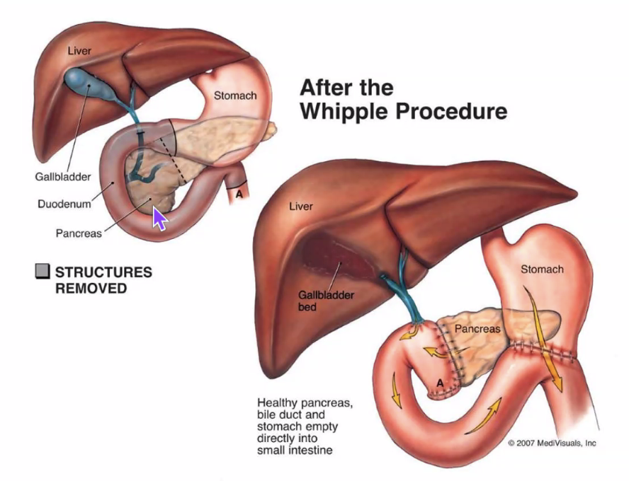 Whipple Procedure