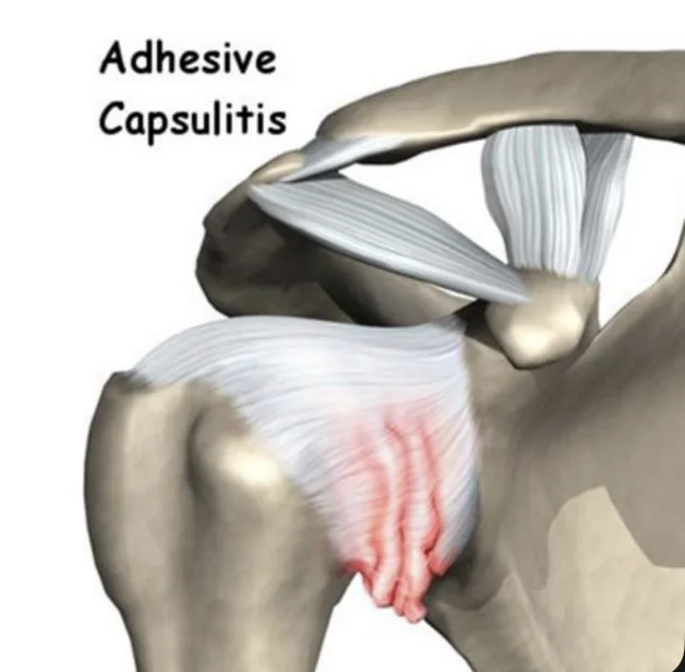 Adhesive Capsulitis