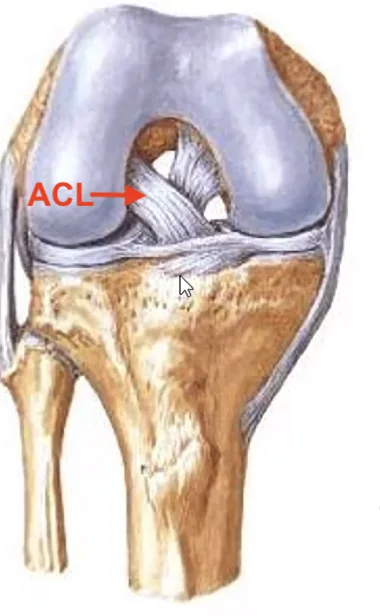 Anterior Cruciate Ligament (right)