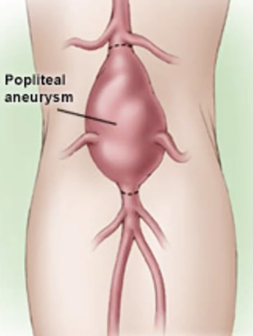 Popliteal Artery Aneurysm