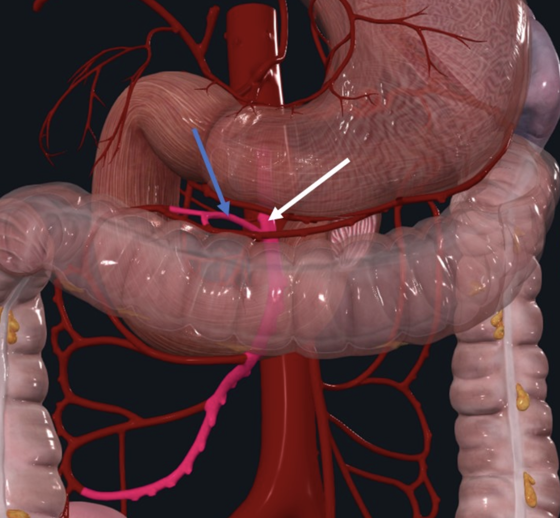 Middle Colic Artery מסומן בתמונה בחץ כחול. מקורו ב־SMA שמסומן בחץ לבן. מספק את ה־ Rt. Colic flexure וה־Transvers colon