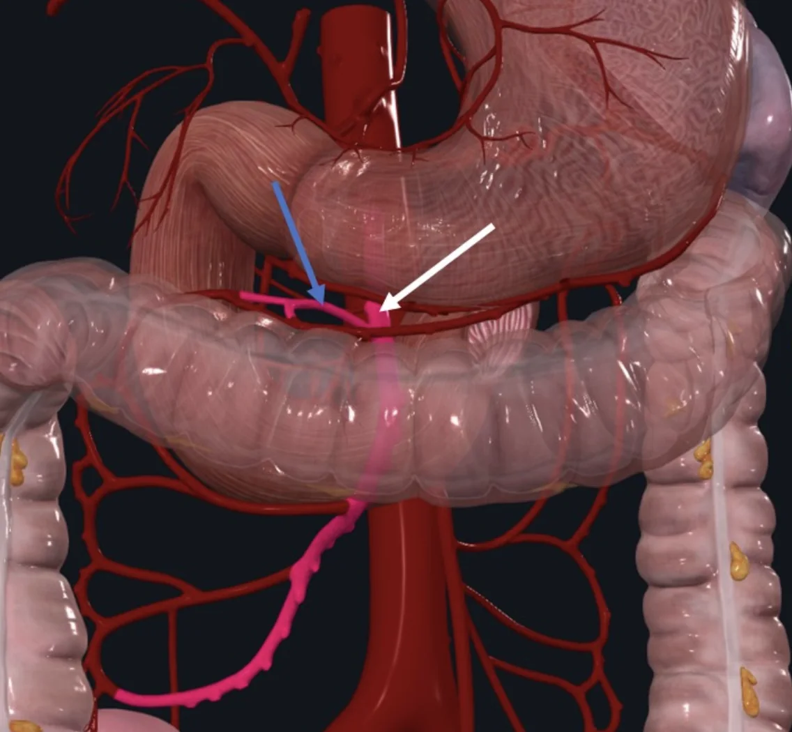 Middle Colic Artery (חץ כחול) מקורו ב־SMA (חץ לבן); מספק את ה־ Rt. Colic flexure וה־Transverse colon