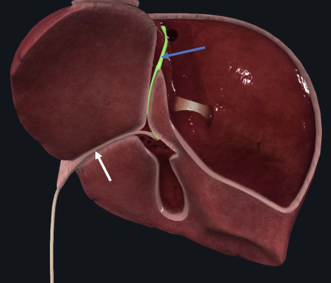 Ligamentum teres מסומנת בתמונה בחץ לבן. היא ההמשך האינפריורי של ligamentum venosum