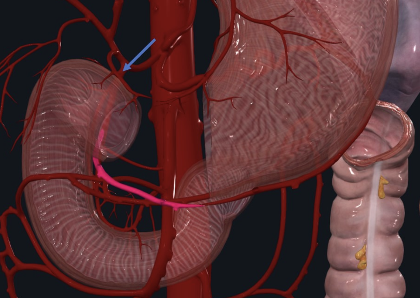Right Gastro-omental Artery - מסומן בצבע בהיר. מקורו ב־Gastroduodenal artery שמסומן בחץ. מקיף את העקומה הגדולה של הכיבה מימין