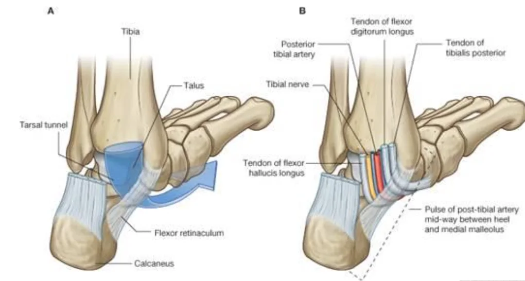 Tarsal Tunnel