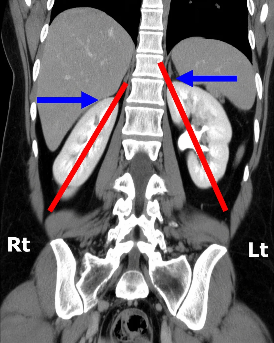 בכחול שריר psoas