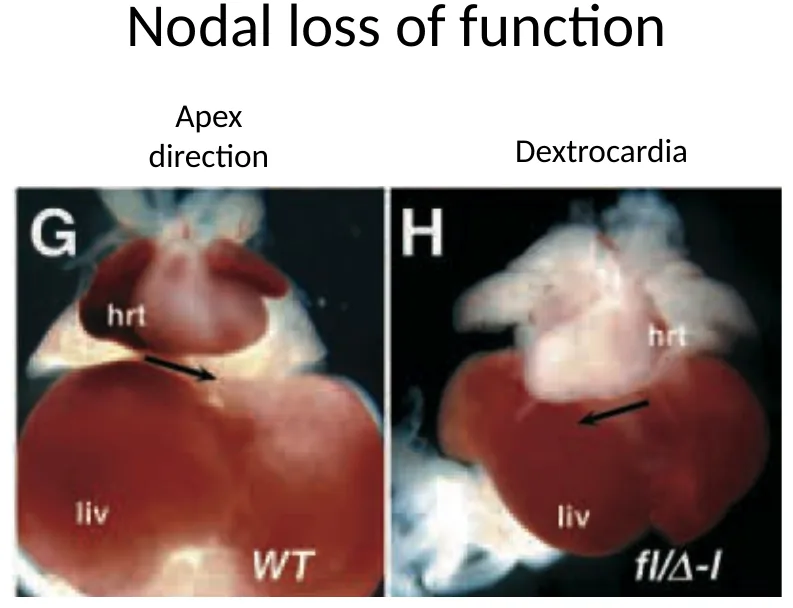 Dextrocardia ב־Nodal loss of function: ה־apex פונה ימינה