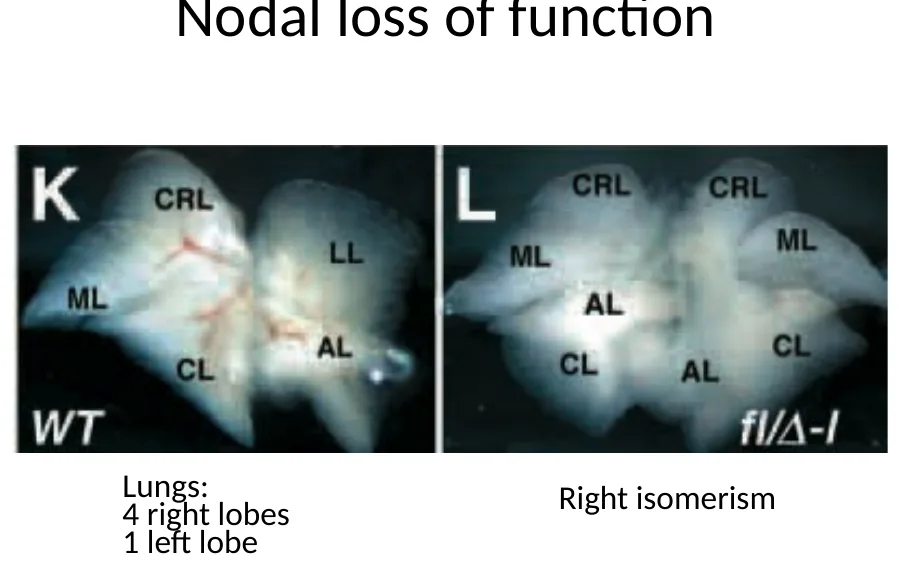 Right isomerism בריאות: ארבע אונות בשני הצדדים