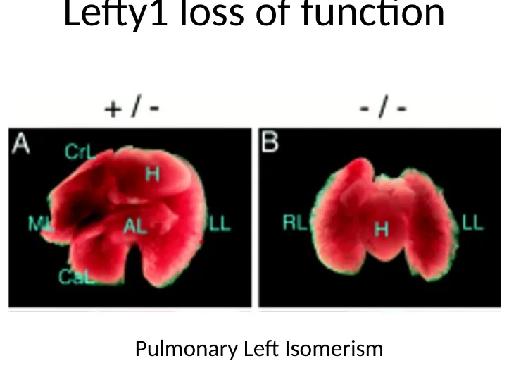 Pulmonary left isomerism: שתי הריאות מקבלות מאפיינים שמאליים