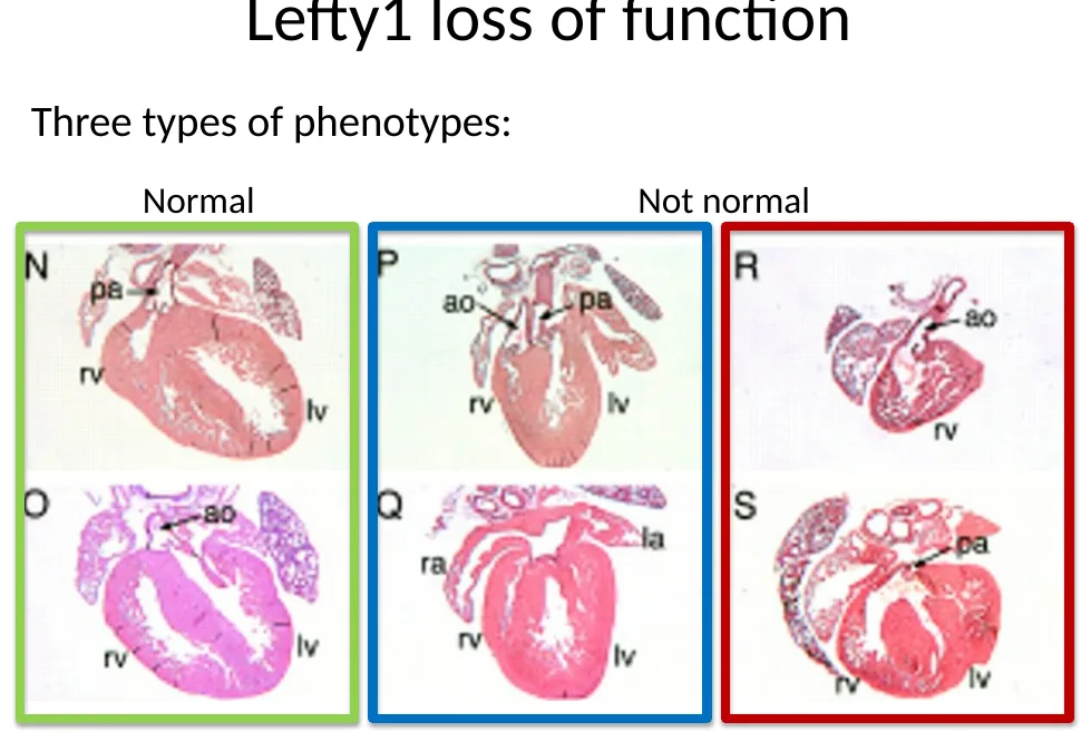 Lefty1 loss of function: דוגמאות לפנוטיפים לבביים שונים