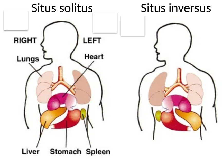 Situs solitus לעומת Situs inversus