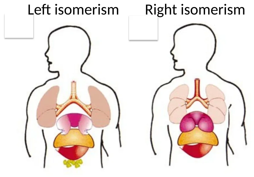 Left isomerism ו־Right isomerism באדם