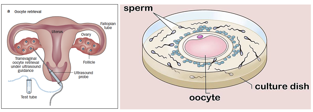 In Vitro Fertilization (IVF)