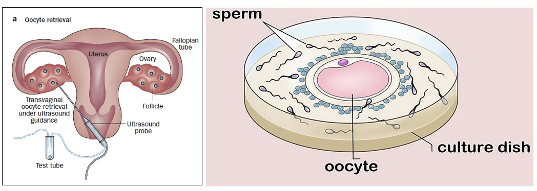 In Vitro Fertilization (IVF)