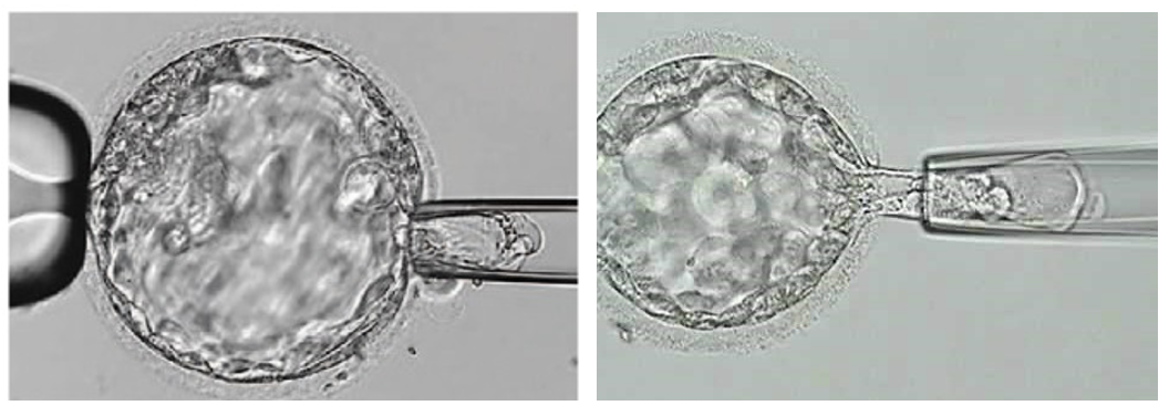 PGD: Blastocyst stage