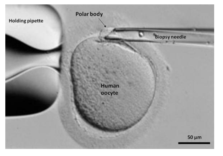 PGD: oocyte stage