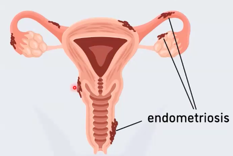 Endometriosis
