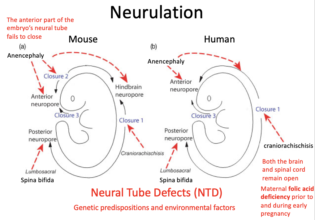 Neural Tube Defects (NTD)