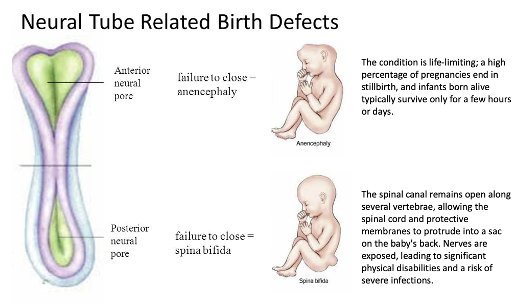Anecephaly and spina bifida