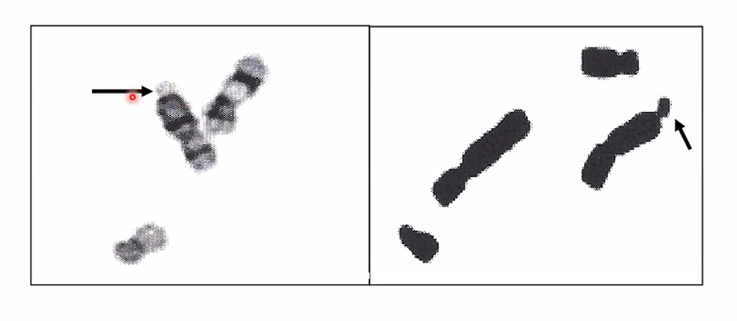 כרומוזום שנאכל בקצה - חסרה צפיפות בקצה