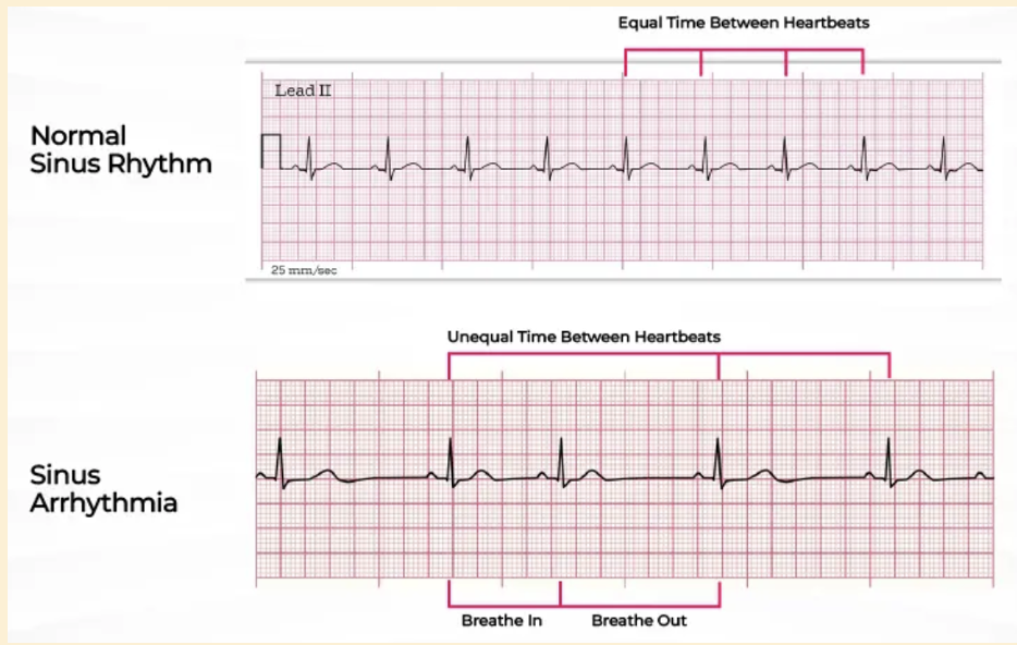 Sinus Arrhythmia