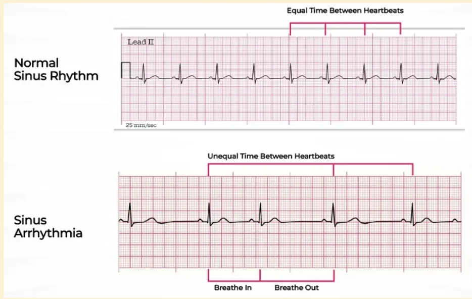 Sinus Arrhythmia