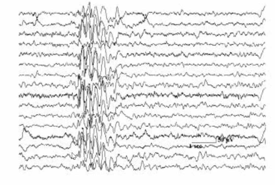 EFG in epilepcy