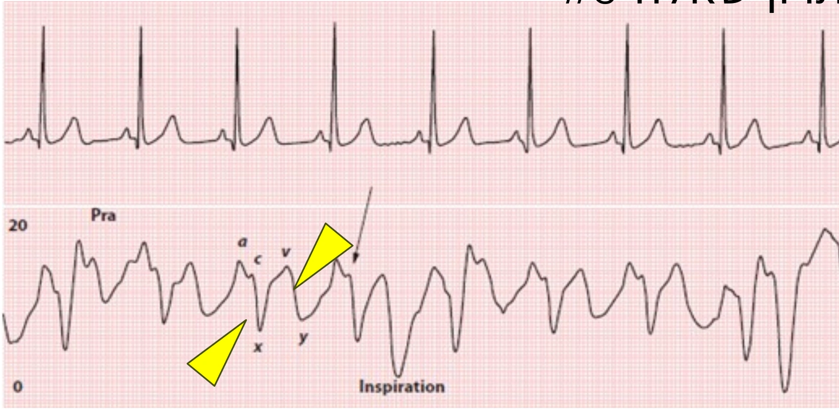 CVP abnormal
