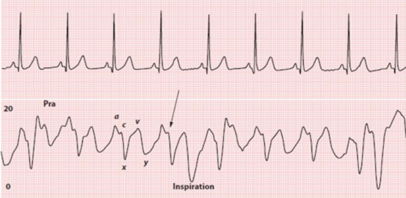 CVP question